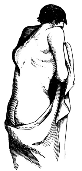 Drawing of a person suffering from Pott’s desease